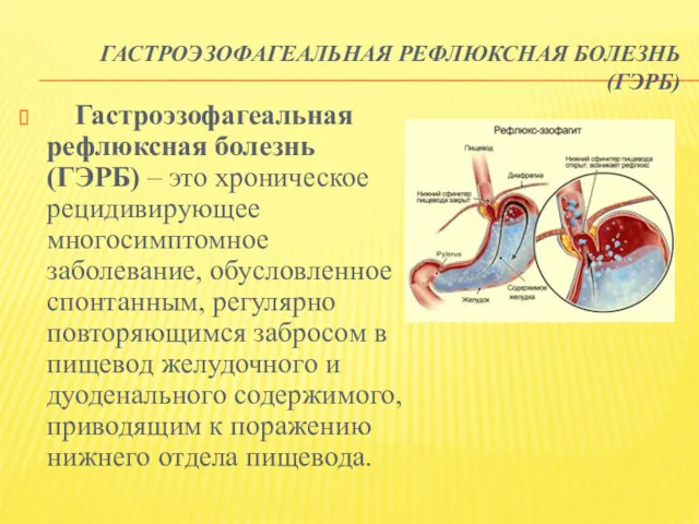 ГАСТРОЭЗОФАГЕАЛЬНАЯ РЕФЛЮКСНАЯ БОЛЕЗНЬ (ГЭРБ) Гастроэзофагеальная рефлюксная болезнь (ГЭРБ) – это