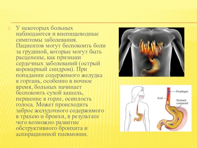 У некоторых больных наблюдаются и внепищеводные симптомы заболевания. Пациентов могут