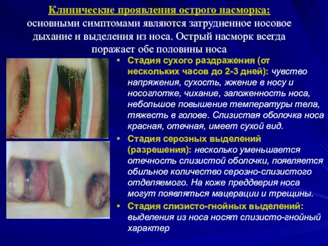 Клинические проявления острого насморка: основными симптомами являются затрудненное носовое дыхание