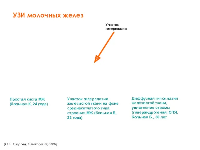 УЗИ молочных желез Простая киста МЖ (больная К, 24 года)