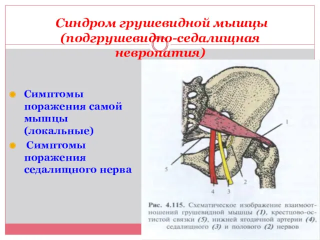Синдром грушевидной мышцы (подгрушевидно-седалищная невропатия) Симптомы поражения самой мышцы (локальные) Симптомы поражения седалищного нерва