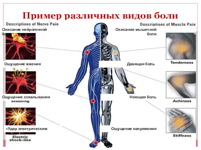 Пример различных видов боли Описание нейрогенной боли Описание мышечной боли