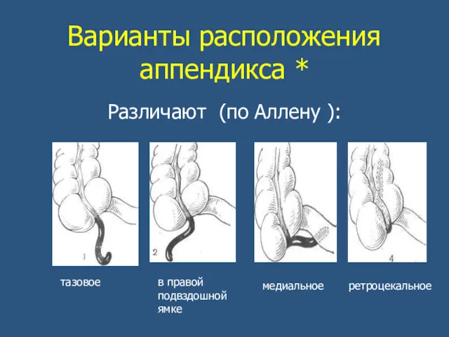 Варианты расположения аппендикса * Различают (по Аллену ): тазовое в правой подвздошной ямке медиальное ретроцекальное