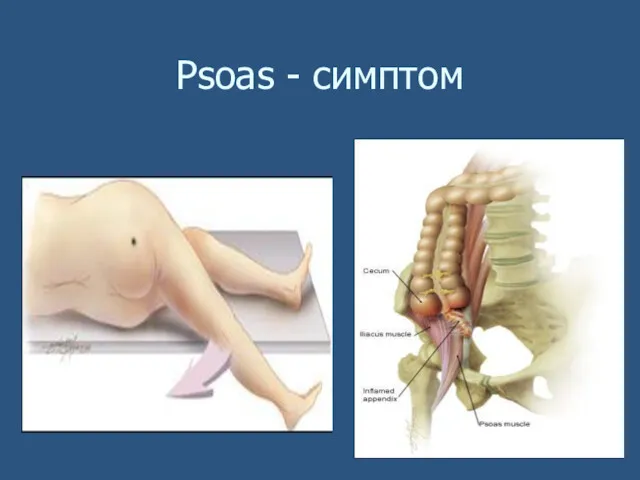 Psoas - симптом