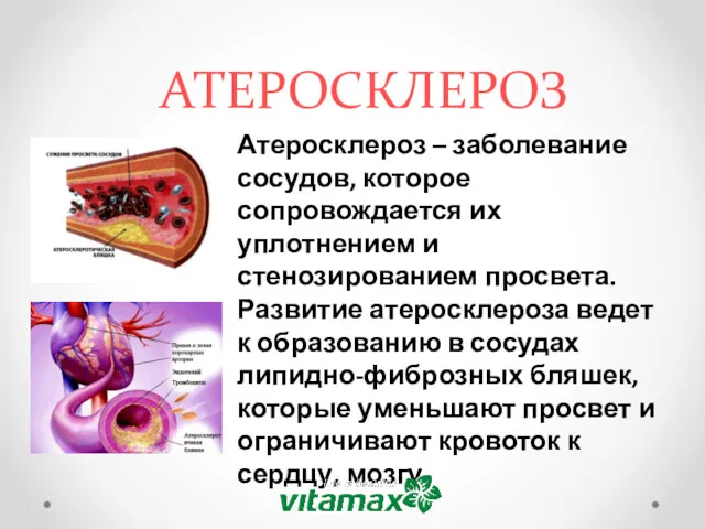 АТЕРОСКЛЕРОЗ Атеросклероз – заболевание сосудов, которое сопровождается их уплотнением и стенозированием просвета. Развитие