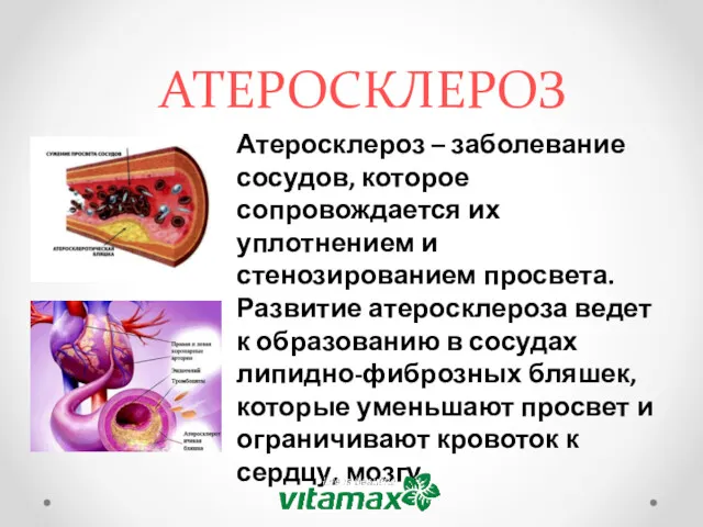 АТЕРОСКЛЕРОЗ Атеросклероз – заболевание сосудов, которое сопровождается их уплотнением и