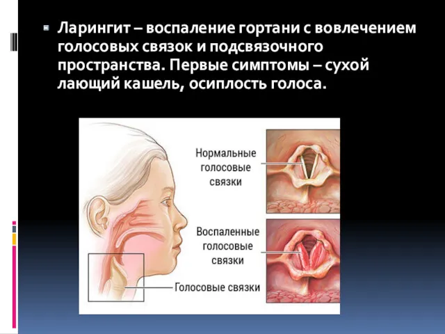 Ларингит – воспаление гортани с вовлечением голосовых связок и подсвязочного