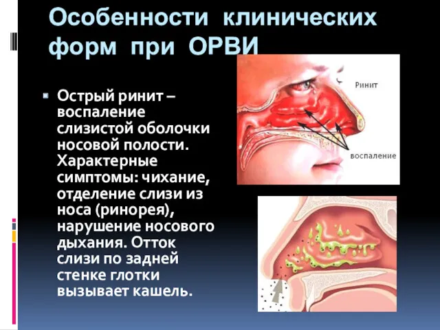 Особенности клинических форм при ОРВИ Острый ринит – воспаление слизистой оболочки носовой полости.
