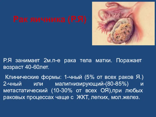 Рак яичника (Р.Я) Р.Я занимает 2м.п-е рака тела матки. Поражает