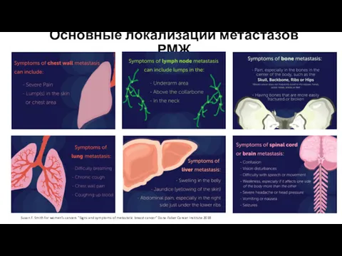 Основные локализации метастазов РМЖ Susan F. Smith for women’s cancers