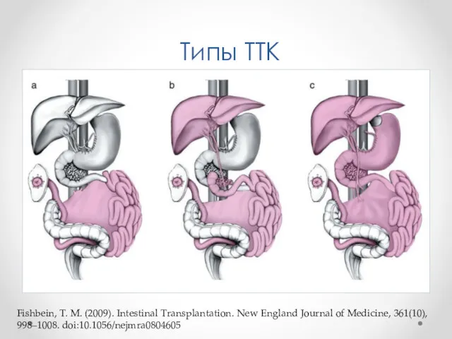 Типы ТТК Fishbein, T. M. (2009). Intestinal Transplantation. New England Journal of Medicine, 361(10), 998–1008. doi:10.1056/nejmra0804605