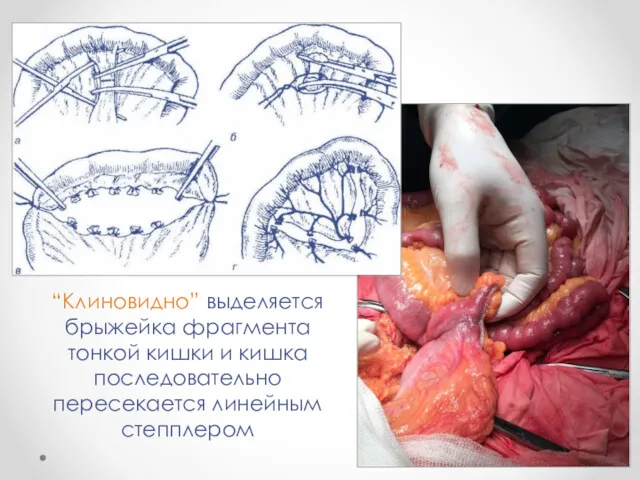 “Клиновидно” выделяется брыжейка фрагмента тонкой кишки и кишка последовательно пересекается линейным степплером