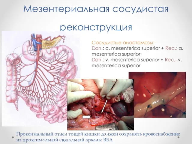 Мезентериальная сосудистая реконструкция Сосудистые анастомозы: Don.: a. mesenterica superior +