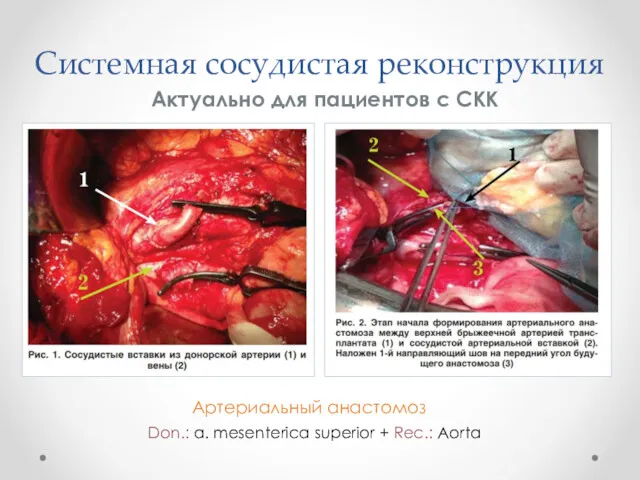 Системная сосудистая реконструкция Актуально для пациентов с СКК Артериальный анастомоз