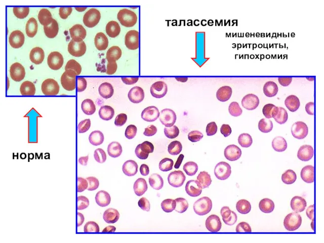 мишеневидные эритроциты, гипохромия