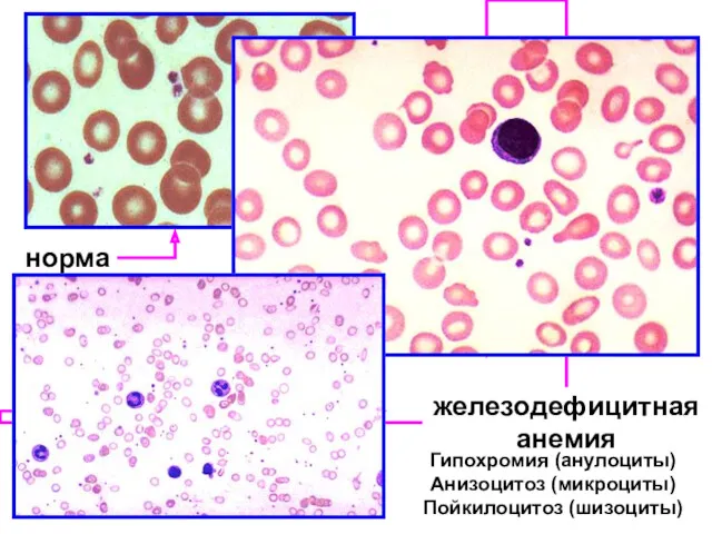 Гипохромия (анулоциты) Анизоцитоз (микроциты) Пойкилоцитоз (шизоциты)