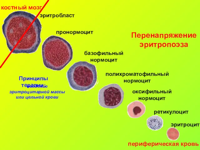 костный мозг периферическая кровь Перенапряжение эритропоэза Принципы терапии: введение эритроцитарной массы или цельной крови