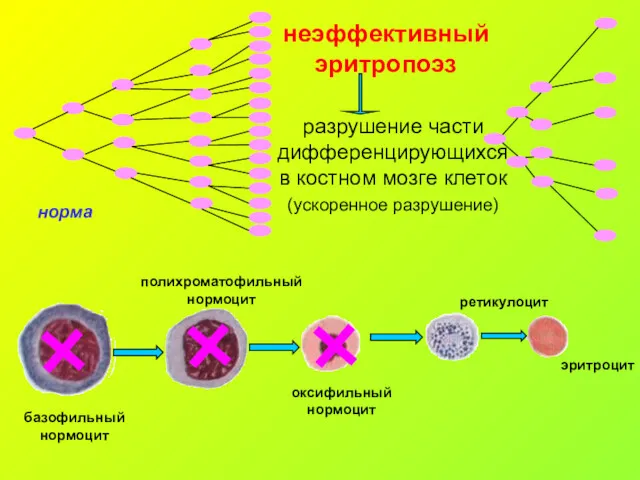 неэффективный эритропоэз разрушение части дифференцирующихся в костном мозге клеток (ускоренное разрушение)