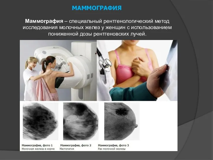 МАММОГРАФИЯ Маммография – специальный рентгенологический метод исследования молочных желез у женщин с использованием