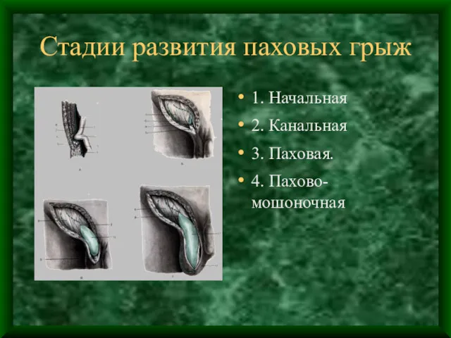 Стадии развития паховых грыж 1. Начальная 2. Канальная 3. Паховая. 4. Пахово-мошоночная