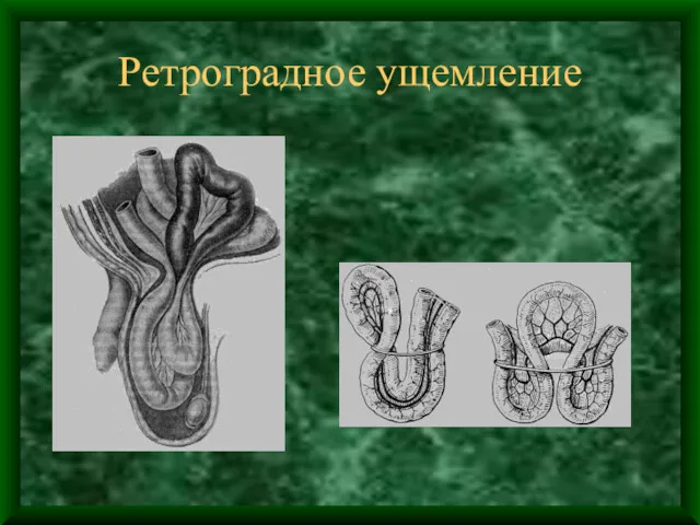 Ретроградное ущемление