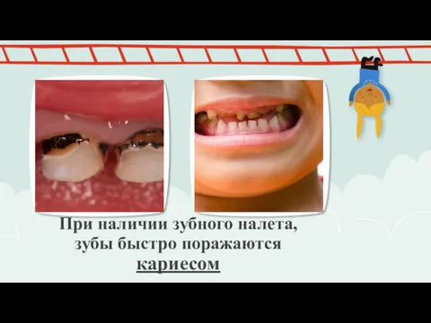 При наличии зубного налета, зубы быстро поражаются кариесом