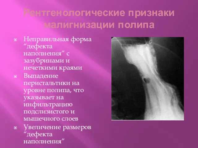 Рентгенологические признаки малигнизации полипа Неправильная форма “дефекта наполнения” с зазубринами