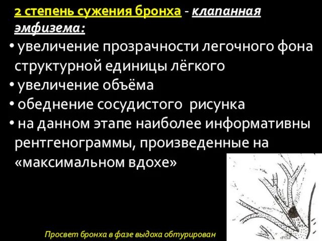 2 степень сужения бронха - клапанная эмфизема: увеличение прозрачности легочного