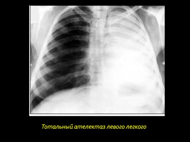 Тотальный ателектаз левого легкого