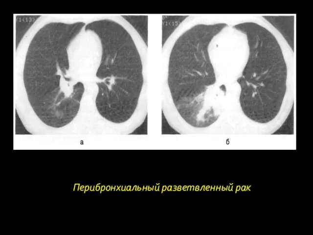 Перибронхиальный разветвленный рак