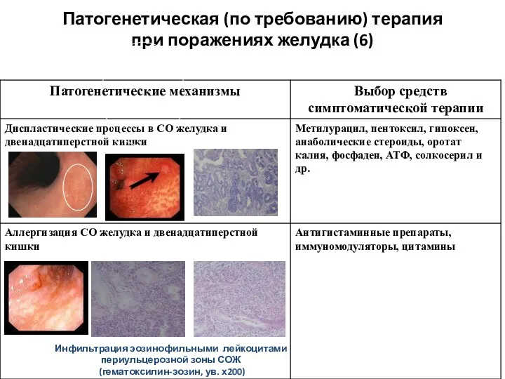 Патогенетическая (по требованию) терапия при поражениях желудка (6) Инфильтрация эозинофильными