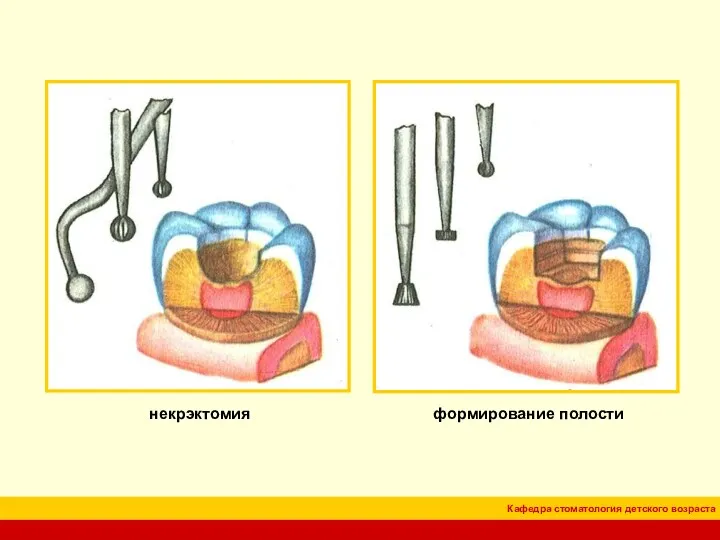 некрэктомия формирование полости