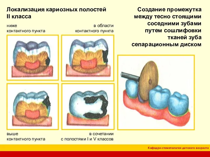 Локализация кариозных полостей II класса в области контактного пункта ниже