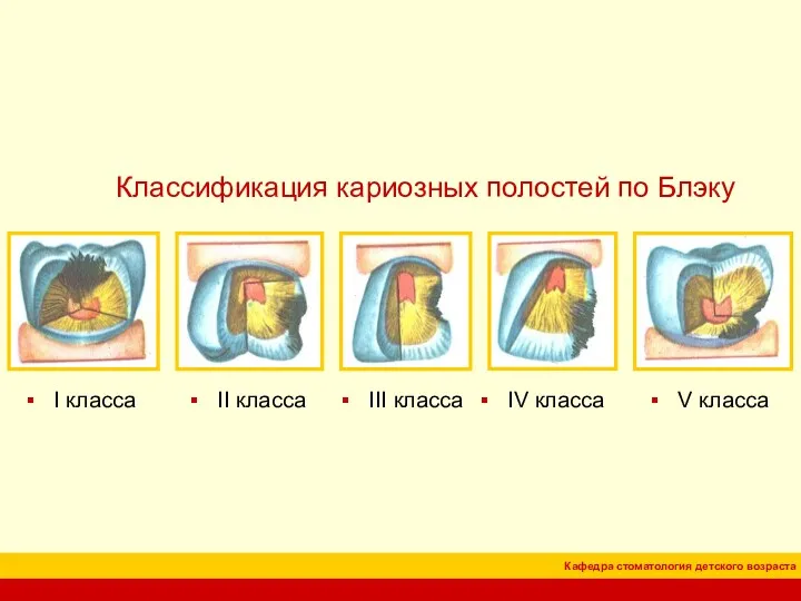 I класса Классификация кариозных полостей по Блэку II класса III класса IV класса V класса