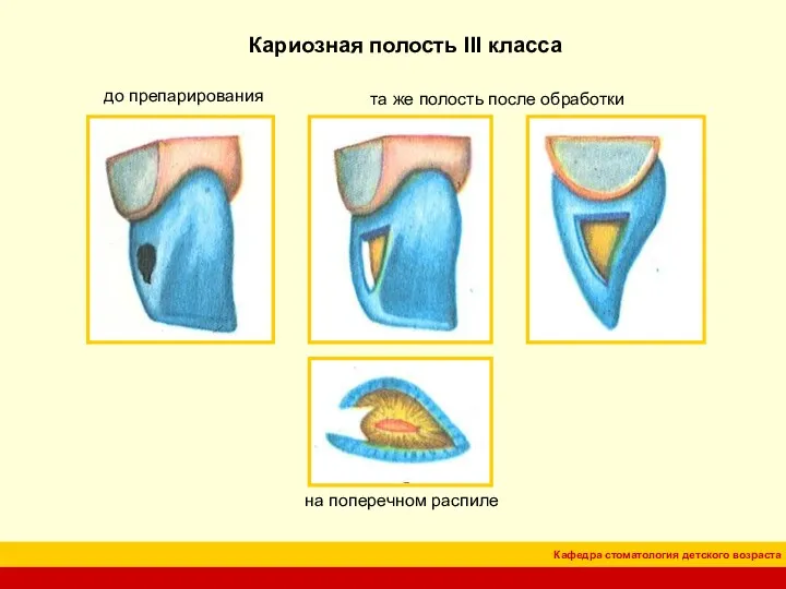 Кариозная полость III класса на поперечном распиле до препарирования та же полость после обработки