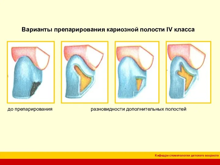 Варианты препарирования кариозной полости IV класса до препарирования разновидности дополнительных полостей