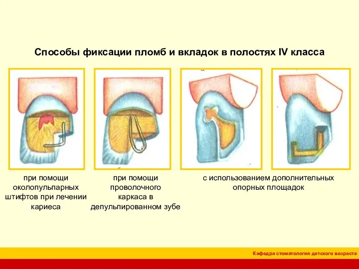 Способы фиксации пломб и вкладок в полостях IV класса при