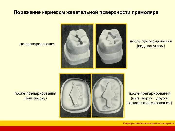 Поражение кариесом жевательной поверхности премоляра до препарирования после препарирования (вид