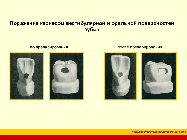 Поражение кариесом вестибулярной и оральной поверхностей зубов до препарирования после препарирования