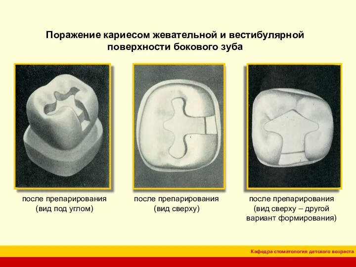 после препарирования (вид под углом) после препарирования (вид сверху) Поражение