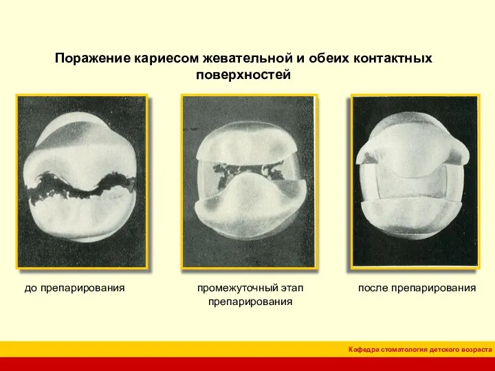 Поражение кариесом жевательной и обеих контактных поверхностей до препарирования промежуточный этап препарирования после препарирования