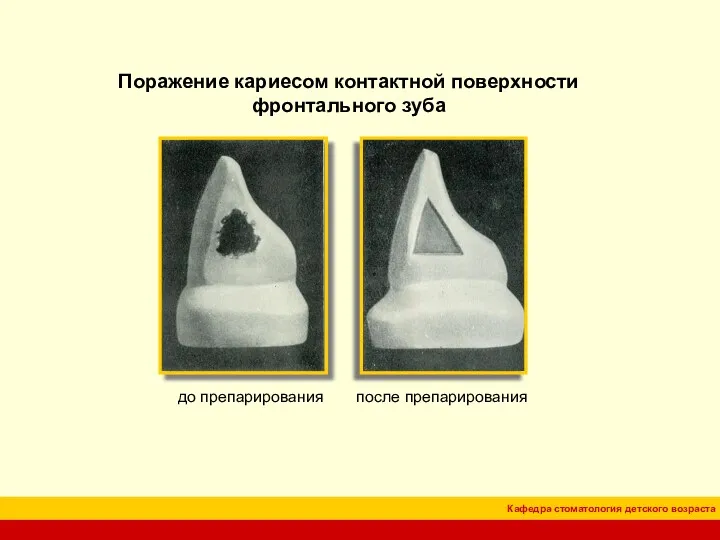 Поражение кариесом контактной поверхности фронтального зуба до препарирования после препарирования