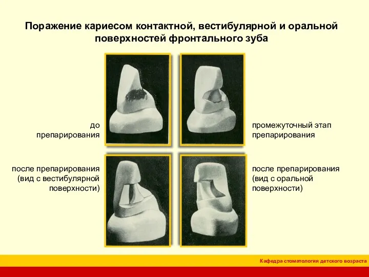 Поражение кариесом контактной, вестибулярной и оральной поверхностей фронтального зуба до