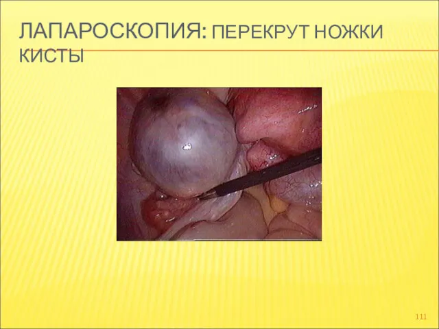 ЛАПАРОСКОПИЯ: ПЕРЕКРУТ НОЖКИ КИСТЫ