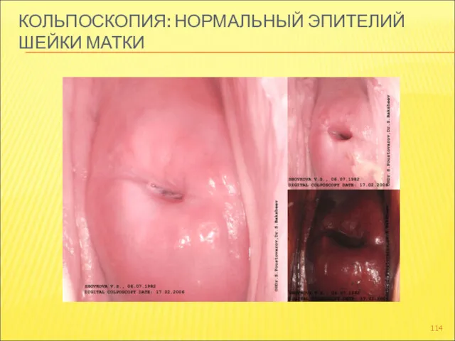 КОЛЬПОСКОПИЯ: НОРМАЛЬНЫЙ ЭПИТЕЛИЙ ШЕЙКИ МАТКИ