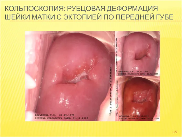 КОЛЬПОСКОПИЯ: РУБЦОВАЯ ДЕФОРМАЦИЯ ШЕЙКИ МАТКИ С ЭКТОПИЕЙ ПО ПЕРЕДНЕЙ ГУБЕ