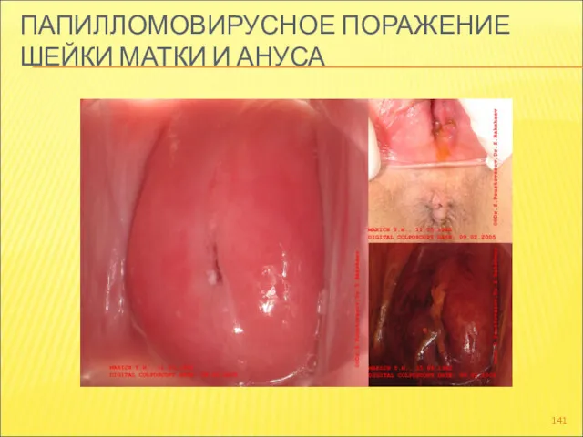 ПАПИЛЛОМОВИРУСНОЕ ПОРАЖЕНИЕ ШЕЙКИ МАТКИ И АНУСА