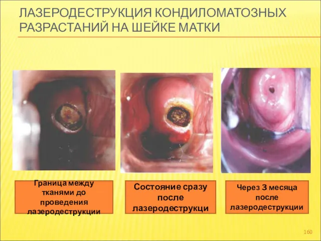 ЛАЗЕРОДЕСТРУКЦИЯ КОНДИЛОМАТОЗНЫХ РАЗРАСТАНИЙ НА ШЕЙКЕ МАТКИ Граница между тканями до