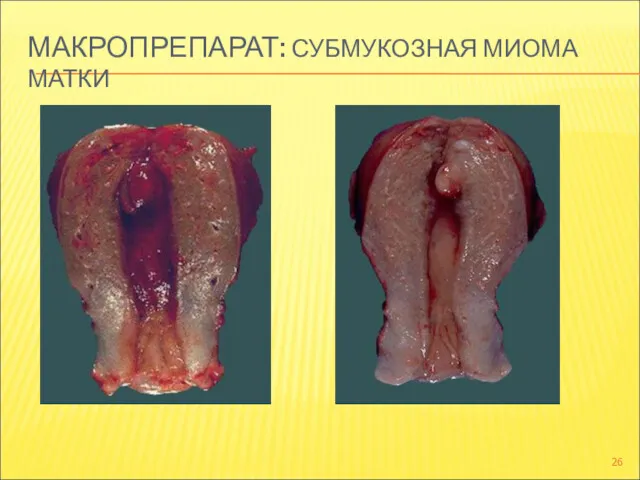 МАКРОПРЕПАРАТ: СУБМУКОЗНАЯ МИОМА МАТКИ