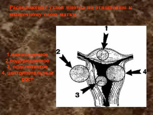 Расположение узлов миомы по отношению к мышечному слою матки. 1.межмышечное 2.подбрюшинное 3. подслизистое 4. центрипетальный рост